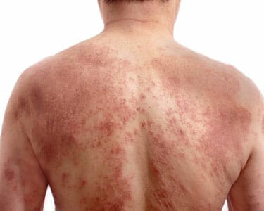 adult male with dermatitis (eczema) on his back